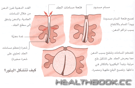 حب الشباب و البثور Be5f4abfcf