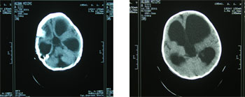 Diagnostikimi dhe përcaktimi i parametrave kryesorë të hidrocefalisë  H7