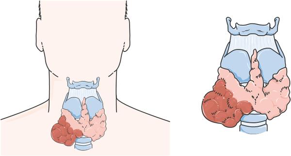 ملف شامل عن الغده الدرقيه Thyroid_Cancer