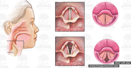 وصفات ونصائح لعلاج بحة الصوت %D8%B9%D9%84%D8%A7%D8%AC-%D8%A8%D8%AD%D8%A9-%D8%A7%D9%84%D8%B5%D9%88%D8%AA
