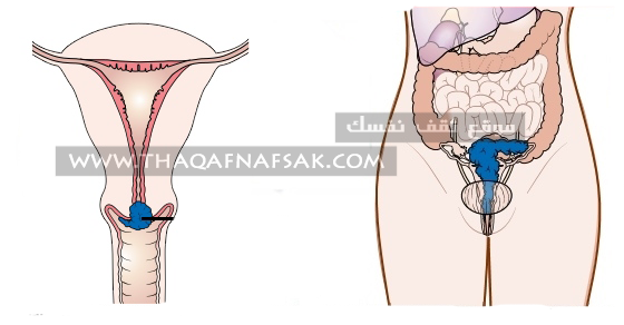  احذرن ٨ علامات على سرطان عنق الرحم  %D8%B3%D8%B1%D8%B7%D8%A7%D9%86-%D8%B9%D9%86%D9%82-%D8%A7%D9%84%D8%B1%D8%AD%D9%85