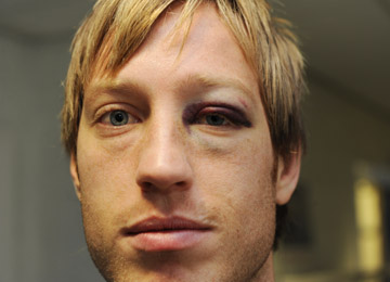 Hitting someone n bans?  Becchio-black-eye