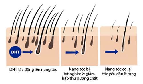 Thuốc chữa rụng tóc ở nam giới chất lượng hàng đầu từ Hoa Kỳ DHT-Copy