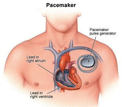 pff Pacemaker101