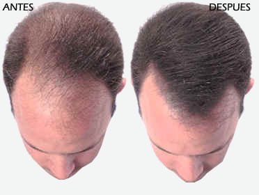 Relacionar con imagenes - Página 9 Transplante_de_pelo_0