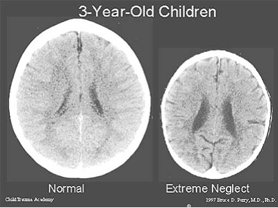 Psychische mishandeling en emotionele verwaarlozing van kinderen Hersens-kind