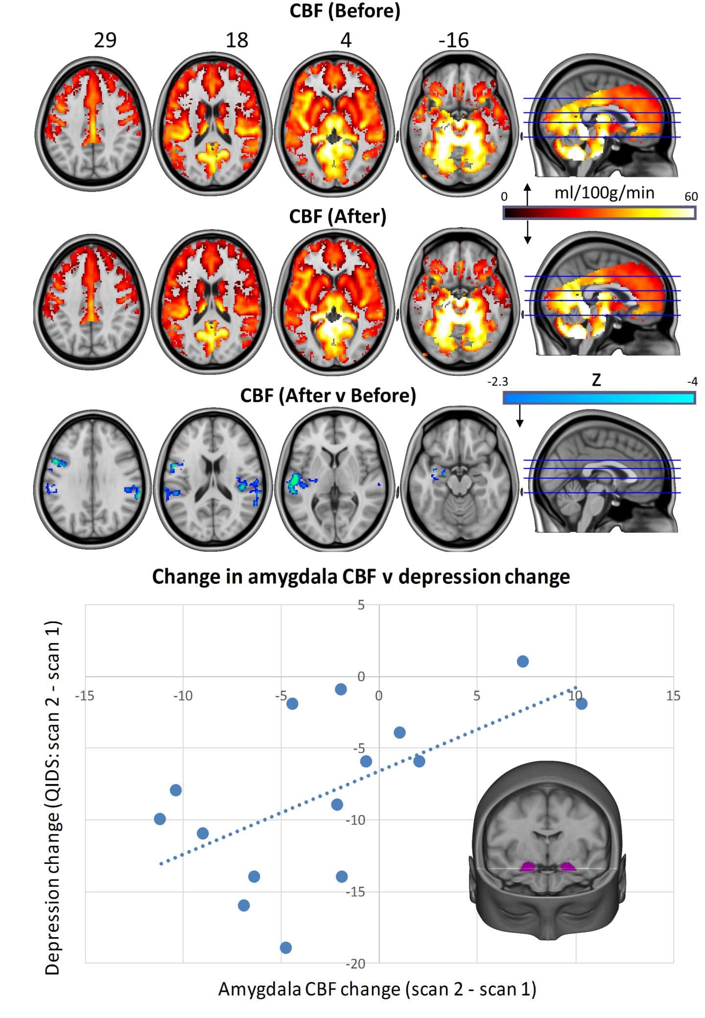 Psilocybin Appears to ‘Reset’ Brain Activity of Depressed Patients Magic-mushrooms-brains-depression