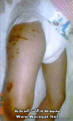 تعذيب طفله عمرها 5 سنوات بالصور T3zeeb_reem3