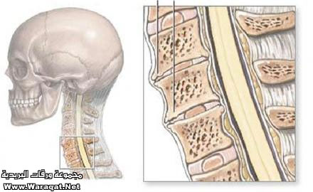 الإنزلاق الغضروفي الرقبي Broblem_bady