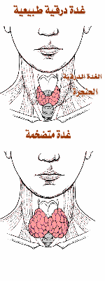  متلازمة بندرد Pendred syndrome Goiter