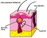 Điều trị và phòng ngừa mụn trứng cá 04120305