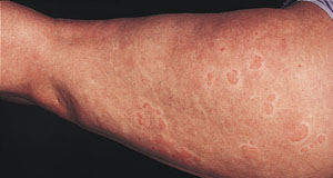 معظم امراض الجلد بالصور هنا...لا تضيع الفرصة لتستفيد  Urticaria_arm