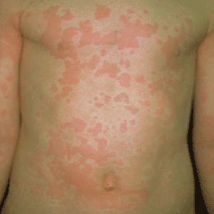  معظم امراض الجلد بالصور هنا...لا تضيع الفرصة لتستفيد  Urticaria_trunk