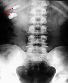 احجار حصوات الكلى والمثانه وطرق الوقايه منها Kidney_staghorn_xray