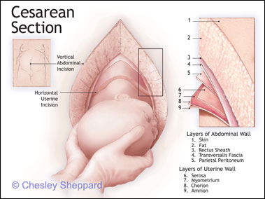 العملية القيصرية بالصور Anat_c_cesarean