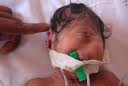 ولادة طفل عراقي بعين واحدة منتصف الوجه في مدينة الناصرية 876024869