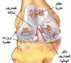 امراض الركبة و المفاصل و علاجها ! 570385866