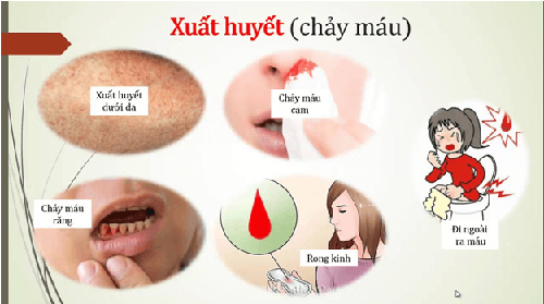 Biểu hiện của bệnh sốt xuất huyết và cách phòng bệnh Trieu-chung-sot-xuat-huyet