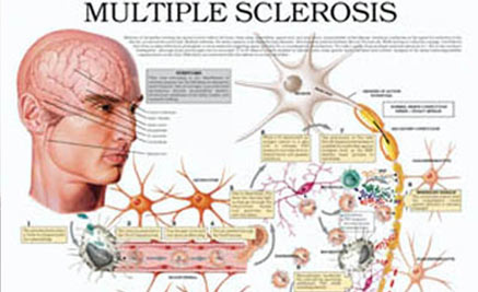  ESCLEROSIS MÚLTIPLE JCulgy