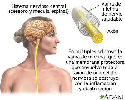  ESCLEROSIS MÚLTIPLE 3oWdhg