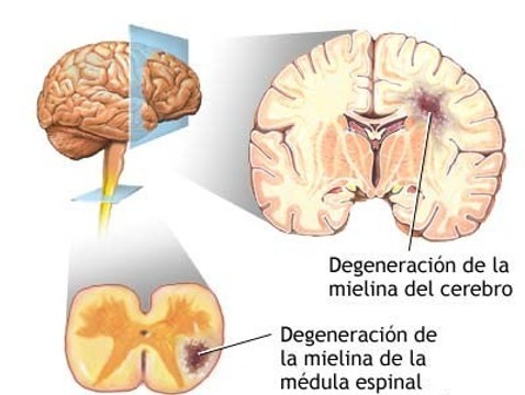  ESCLEROSIS MÚLTIPLE Bwgnnp