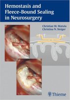 neurosurgery - Hemostasis and Fleece-Bound Sealing in Neurosurgery V49x9p