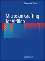 Microskin Grafting for Vitiligo 0KnTBC