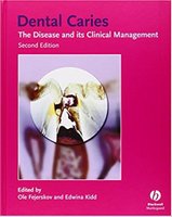 Dental Caries The Disease and Its Clinical Management 1NZ65G