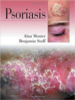 Psoriasis By Alan Menter E57VID
