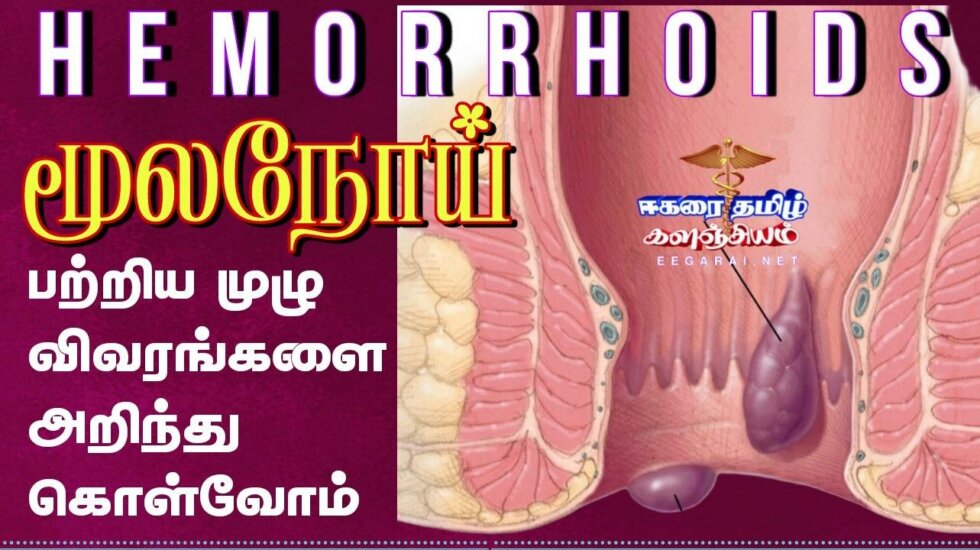 Topics tagged under hemorrhoids on ஈகரை தமிழ் களஞ்சியம் 6_1_980x550