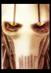 grievous