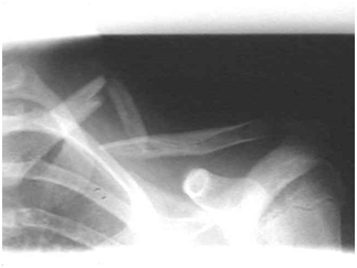 clavicle fracture2