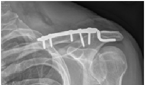 clavicle fracture5