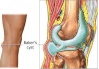 baker's cyst