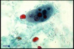 Entamoeba histolytica