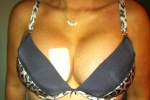 Breast Uplift/Reduction and Nipple Lift Surgeries 5650-17