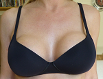 General Breast Augmentation 7269-47