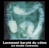 Lavement baryt du colon en double contraste