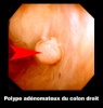 Polype adenomateux du colon droit